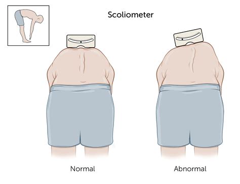 torsion scoliosis test|scans for scoliosis.